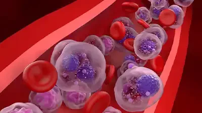 Cemmp-Noticia-Estas son las características del mieloma múltiple, uno de los cánceres más frecuentes de la sangre
