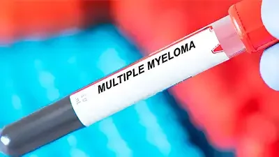 Noticia-Cemmp-Mieloma múltiple glóbulos blancos que deterioran los huesos